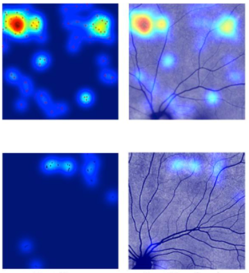 Looking for Alzheimer’s in the Eye